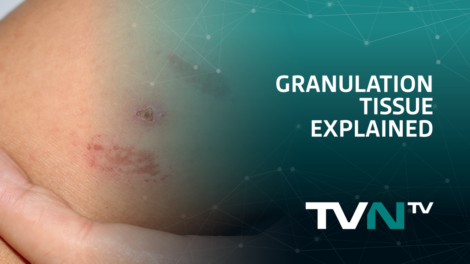 devitalised-non-viable-tissue-explained-tvn-tv